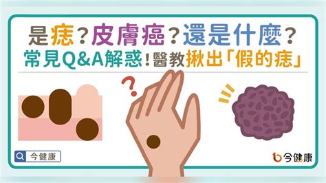 長毛痣|是痣？皮膚癌？還是什麼？常見Q&A解惑！醫教揪出「。